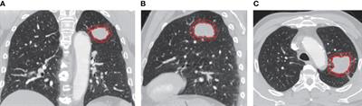 Efficacy of radiomics model based on the concept of gross tumor volume and clinical target volume in predicting occult lymph node metastasis in non-small cell lung cancer